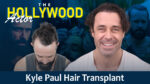 Kyle Paul hair transplant case study showing a Hollywood actor before and after hair restoration with a 3,300-graft procedure