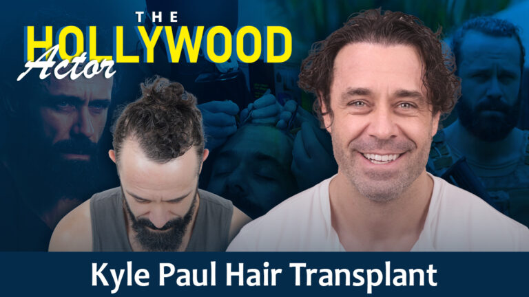 Kyle Paul hair transplant case study showing a Hollywood actor before and after hair restoration with a 3,300-graft procedure