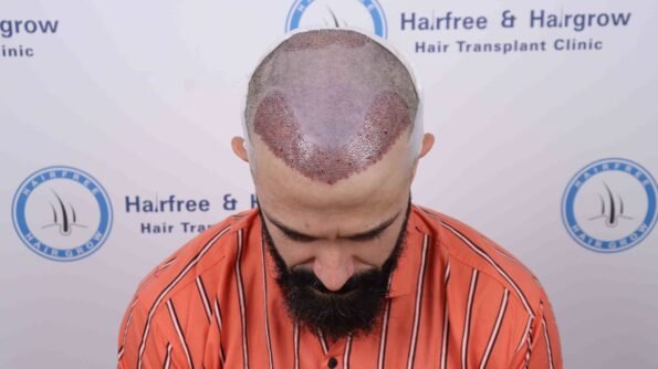 Kyle Paul Hair Transplant next day recovery showing the healing scalp and newly implanted 3,300-graft BIG-FUE hairline during the first post-operative follow-up at HairFree HairGrow Clinic in Surat.