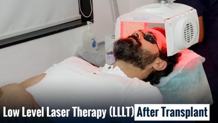 Low Level Laser Therapy (LLLT) after hair transplant treatment to support hair growth and recovery