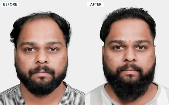 Mahesh hair transplant before and after images showing changes in hair coverage and density