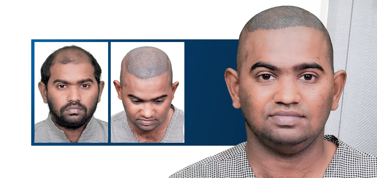 Rama Naidu sharing his experience after hair transplant treatment at HairFree HairGrow Kharadi Pune