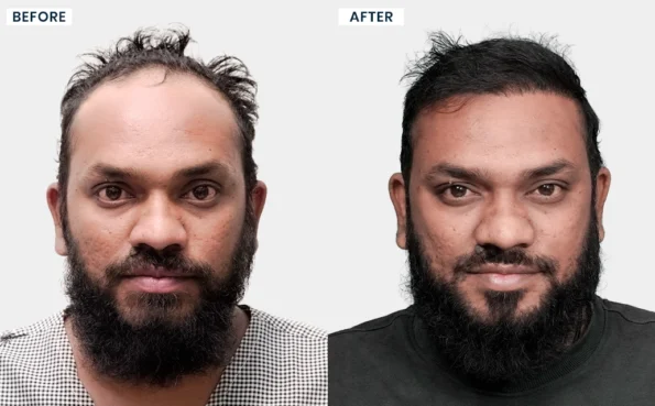 Sabir Khan hair transplant before and after images showing changes in hairline and hair density