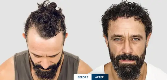 Kyle Paul celebrity hair transplant in India