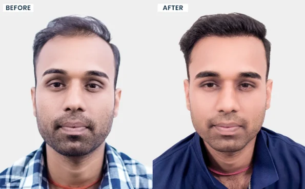 Akhilesh Choudhury before and after hair transplant results at Hairfree & Hairgrow Clinic