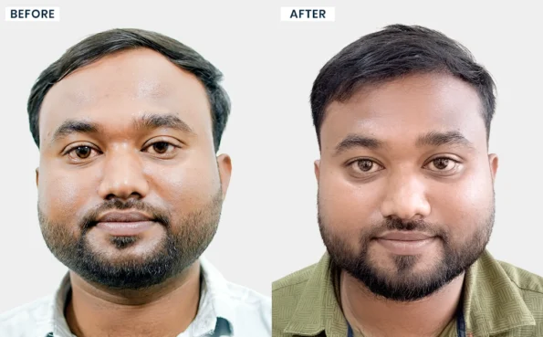 Anish Das before and after hair transplant results at Hairfree & Hairgrow Clinic