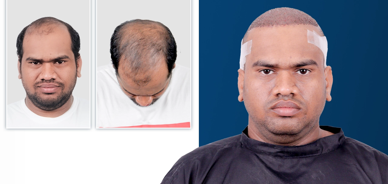 Anuj Gupta hair transplant before and after result - Hairfree and Hairgrow patient