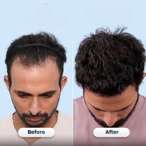 Hair transplant before and after results showing improved hair density