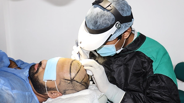 BIG FUE hair transplant technique at HairFree & HairGrow