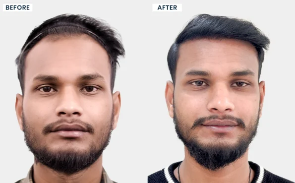 Bapi marjit before and after hair transplant results at Hairfree & Hairgrow Clinic