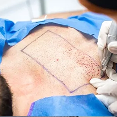 Body Hair Transplant