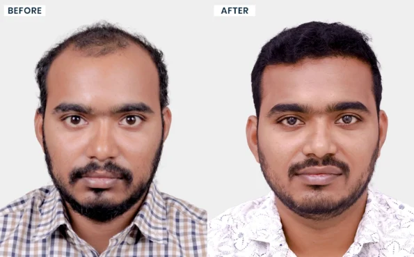 Dyapa Varun Reddy hair transplant before and after result - Hairfree and Hairgrow Bangalore