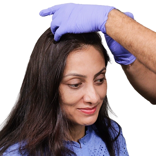 Female Hair Transplant