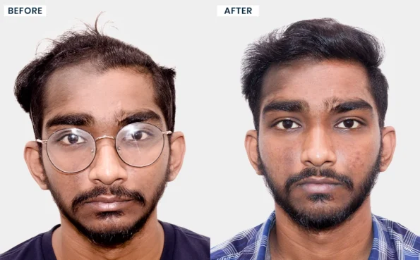 Gautam Venkatesh hair transplant before and after result - Hairfree and Hairgrow Bangalore