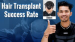 Hair transplant success rate showing a hair transplant procedure and before-and-after hair restoration results.