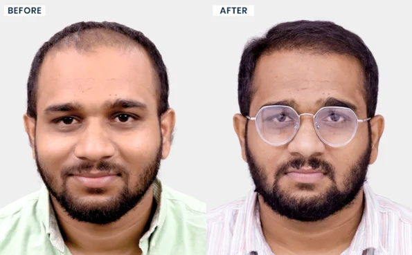 Jagadeesh Kumar hair transplant before and after result - Hairfree and Hairgrow Bangalore