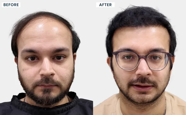 Kaushal Chandarana hair transplant before and after result - Hairfree and Hairgrow Bangalore