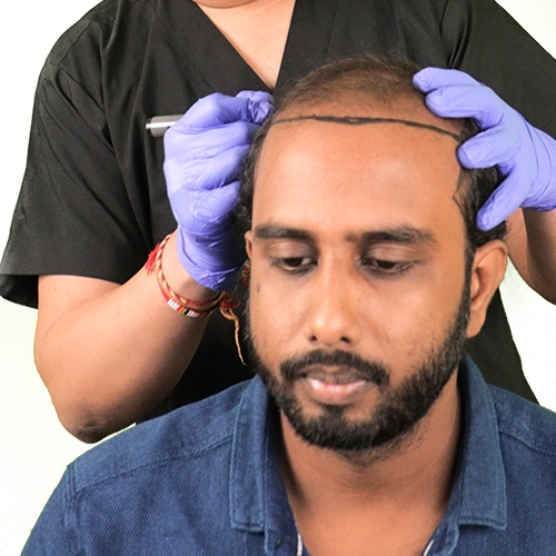 Male Hair Transplant