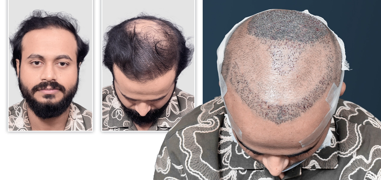 Mimo Dey before hair transplant and during FUE procedure with grafted scalp visible