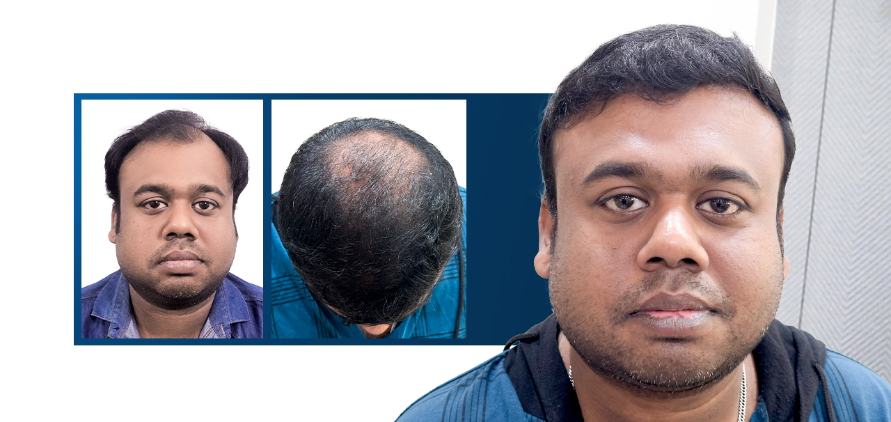 Mukul Basak hair loss and thinning crown before hair transplant treatment