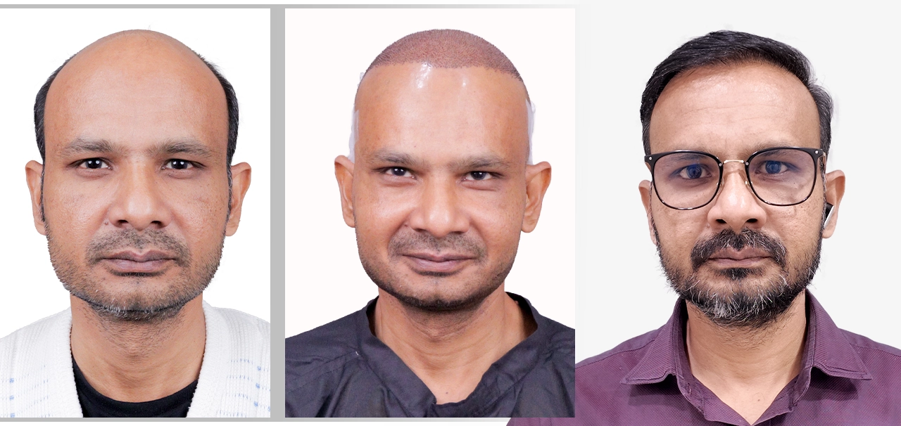 Pramod Singh hair transplant before and after result - Hairfree and Hairgrow patient