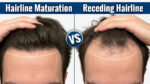 Mature Hairline vs Receding Hairline: How to Tell the Difference