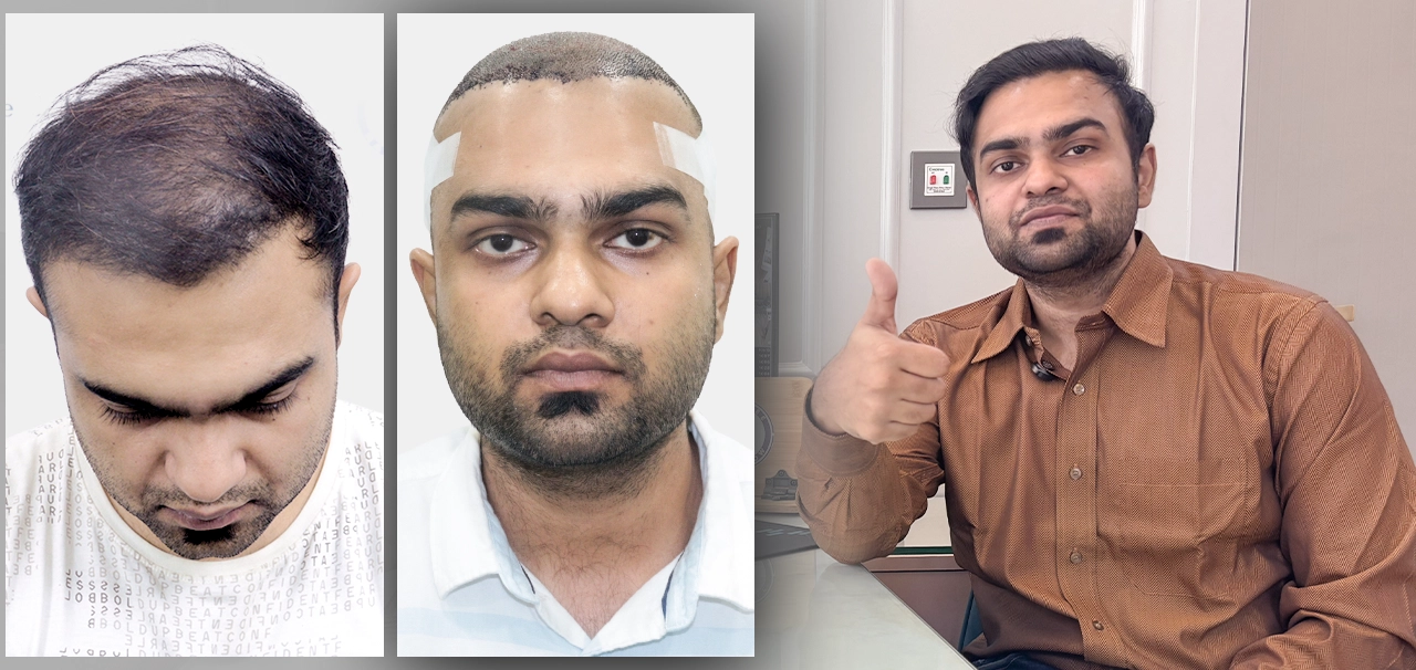 Rohit Basu before hair transplant, post-surgery bandage, and after recovery with thumbs up