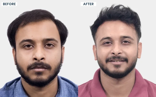 Sabir Khan before and after hair transplant results at Hairfree & Hairgrow Clinic