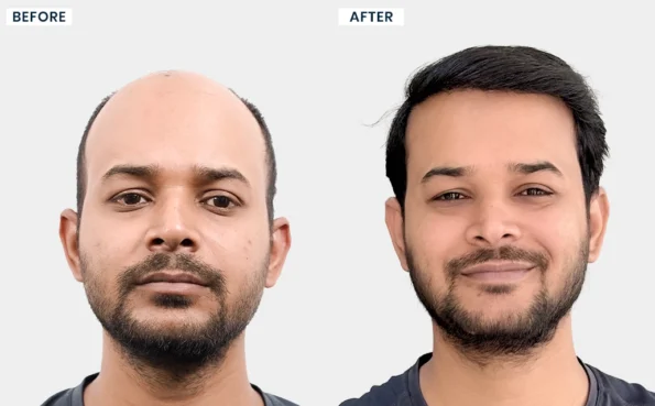 Sashi Kundan before and after hair transplant results at Hairfree & Hairgrow Clinic
