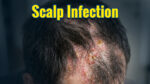 Scalp infection with redness, inflammation, scaling, and crusting on the scalp.
