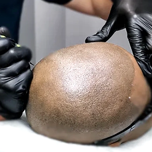 Scalp Micropigmentation SMP