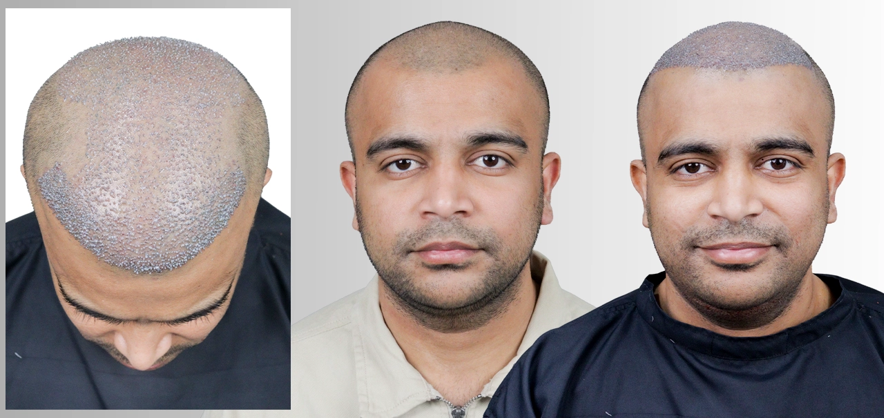 Shashank Kuruvatti hair transplant before and after result - Hairfree and Hairgrow patient