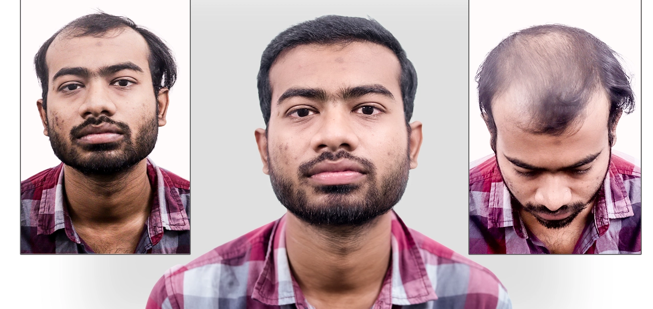 Sourav Kundu hair loss condition before hair transplant at Hairfree & Hairgrow Clinic Kolkata