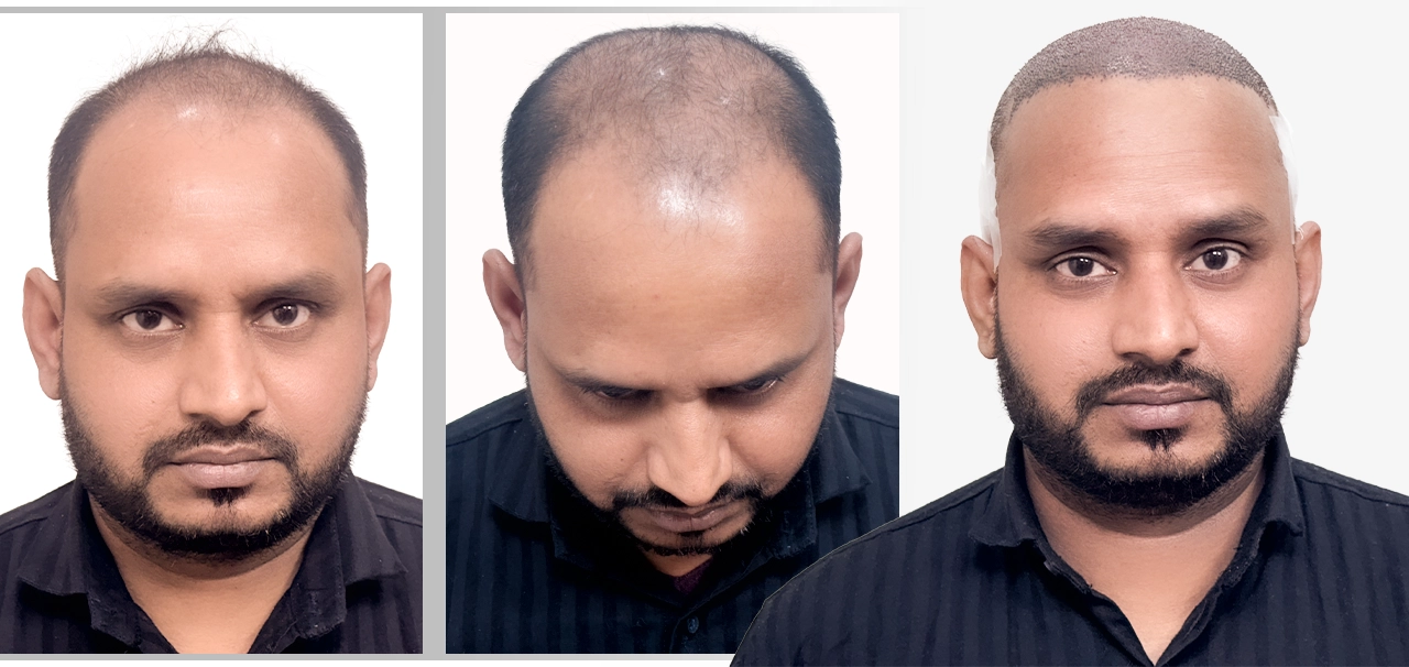Abdul Karim before hair transplant and prepped for FUE procedure with shaved scalp
