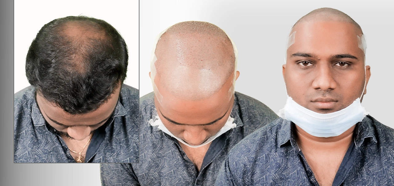 Hari Krishna sharing his hair transplant journey with before and treatment photos in Hyderabad