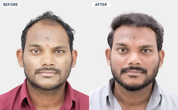 Madhu hair restoration before and after treatment