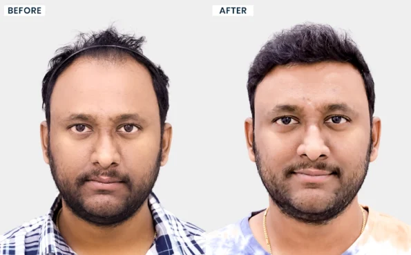 Naveen hair restoration treatment before and after