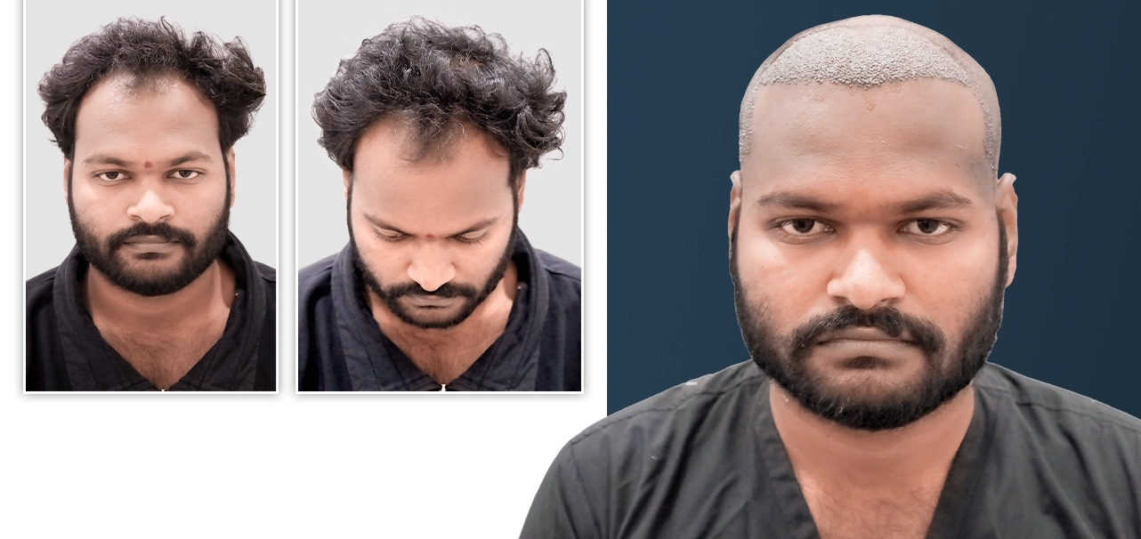 Naveen Kumar showing his hair restoration journey with treatment and before photos