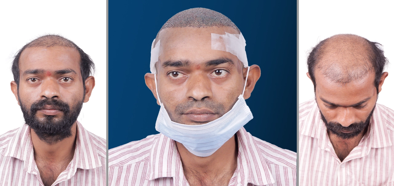 Paavan Kumar hair transplant before and after result - Hairfree and Hairgrow patient