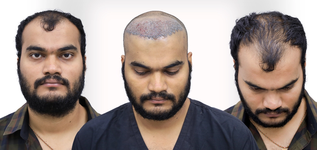 Pawan Sai Sri Harsha during his hair restoration journey at HairFree HairGrow Hyderabad