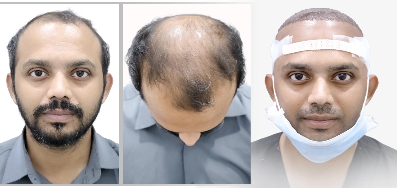 Raju Kundena during his hair transplant journey with pre-treatment and procedure photos