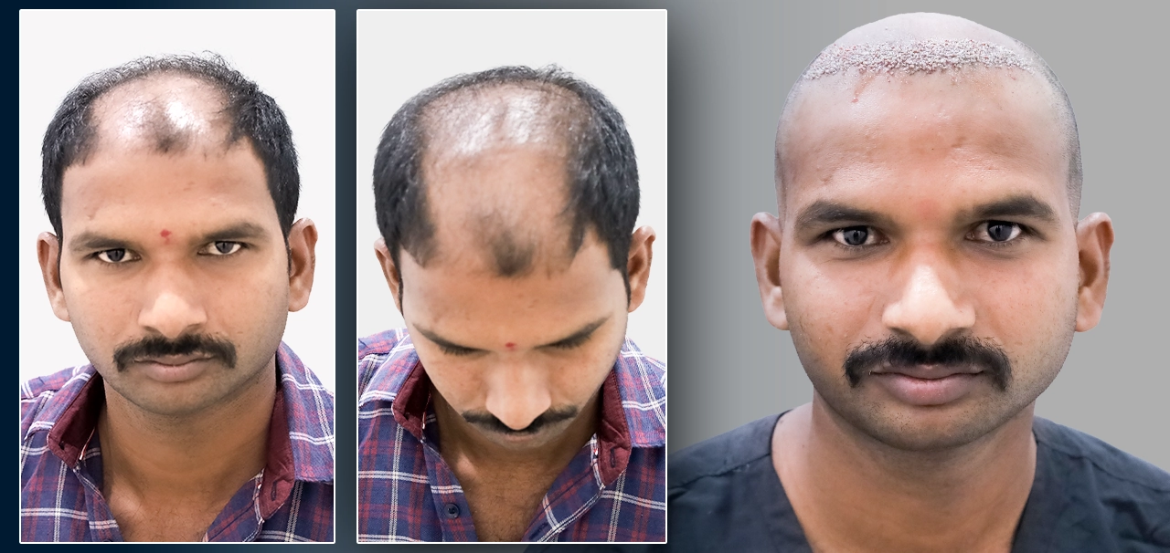 Satish Reddy showing his hair transplant treatment journey with before and after photos