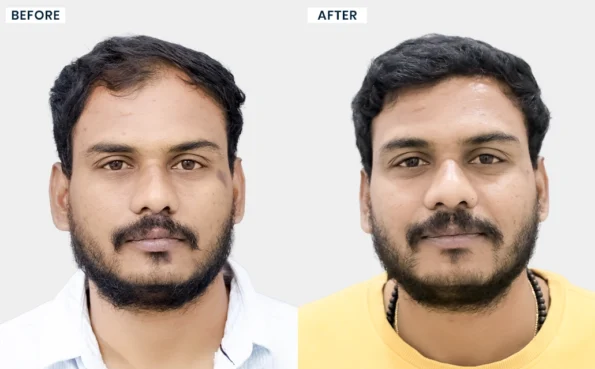 Shrikanth hair specialist treatment before and after