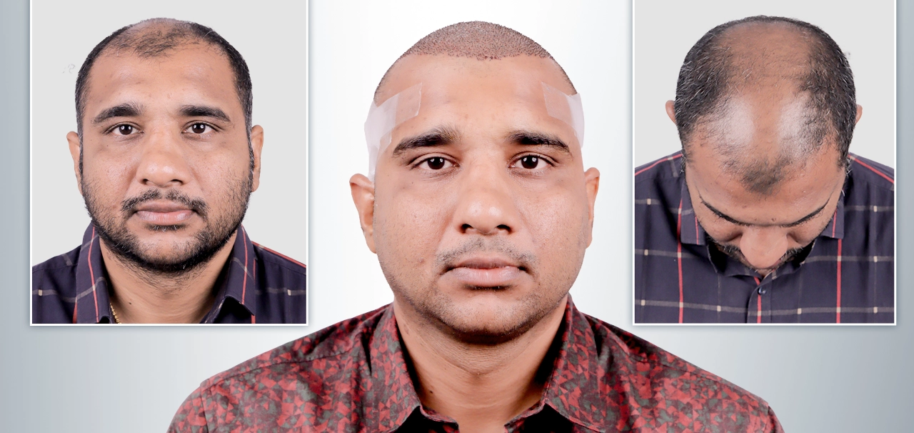 Subhajit Panda hair transplant before and after result - Hairfree and Hairgrow patient