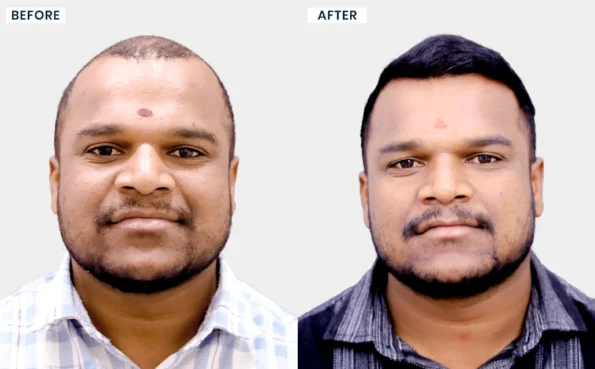 T Raju hair treatment before and after comparison