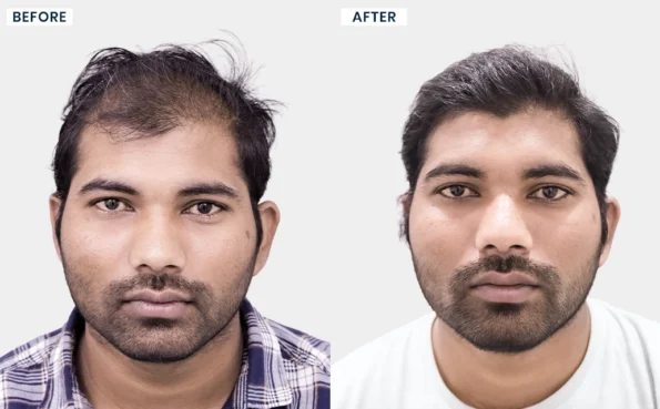 Venkat Naresh hair transplant before and after results