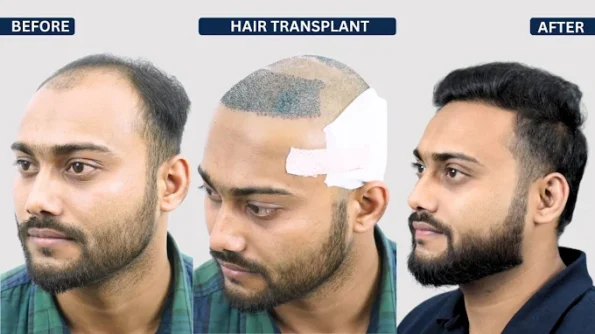 SMP vs hair transplant Illustrative hair transplant before-and-after comparison showing changes in hair coverage