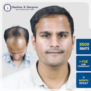 FUE hair transplant before and after: 3,500 grafts with I-FUE technique, 6 month result at Hairfree Hairgrow