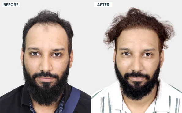Aquib Khan hair transplant before and after results at HairFree HairGrow Bhopal