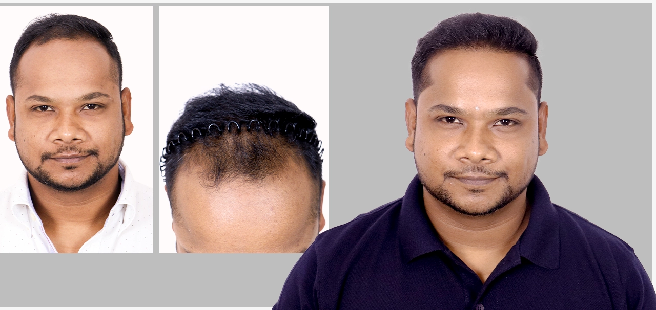 Bhanu Pratap hair transplant testimonial and before after results in Bhopal